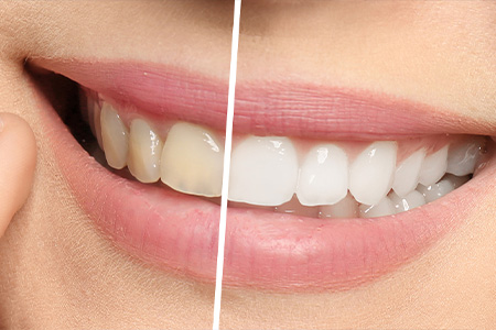 ポイント③：ホワイトニング後の歯の色を考慮