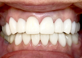 歯の白さを追求する審美セラミック治療