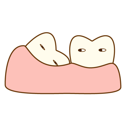 親知らずは抜かないといけない？