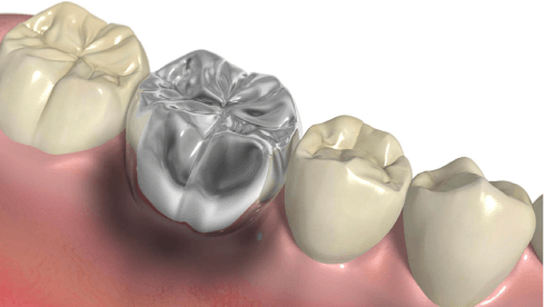 メタルタトゥーとは？