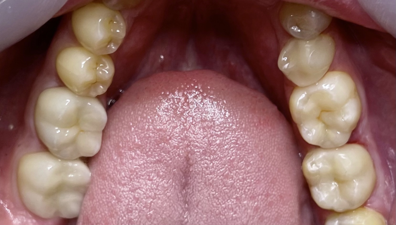 銀歯から、白い歯へ。(メタルフリー)