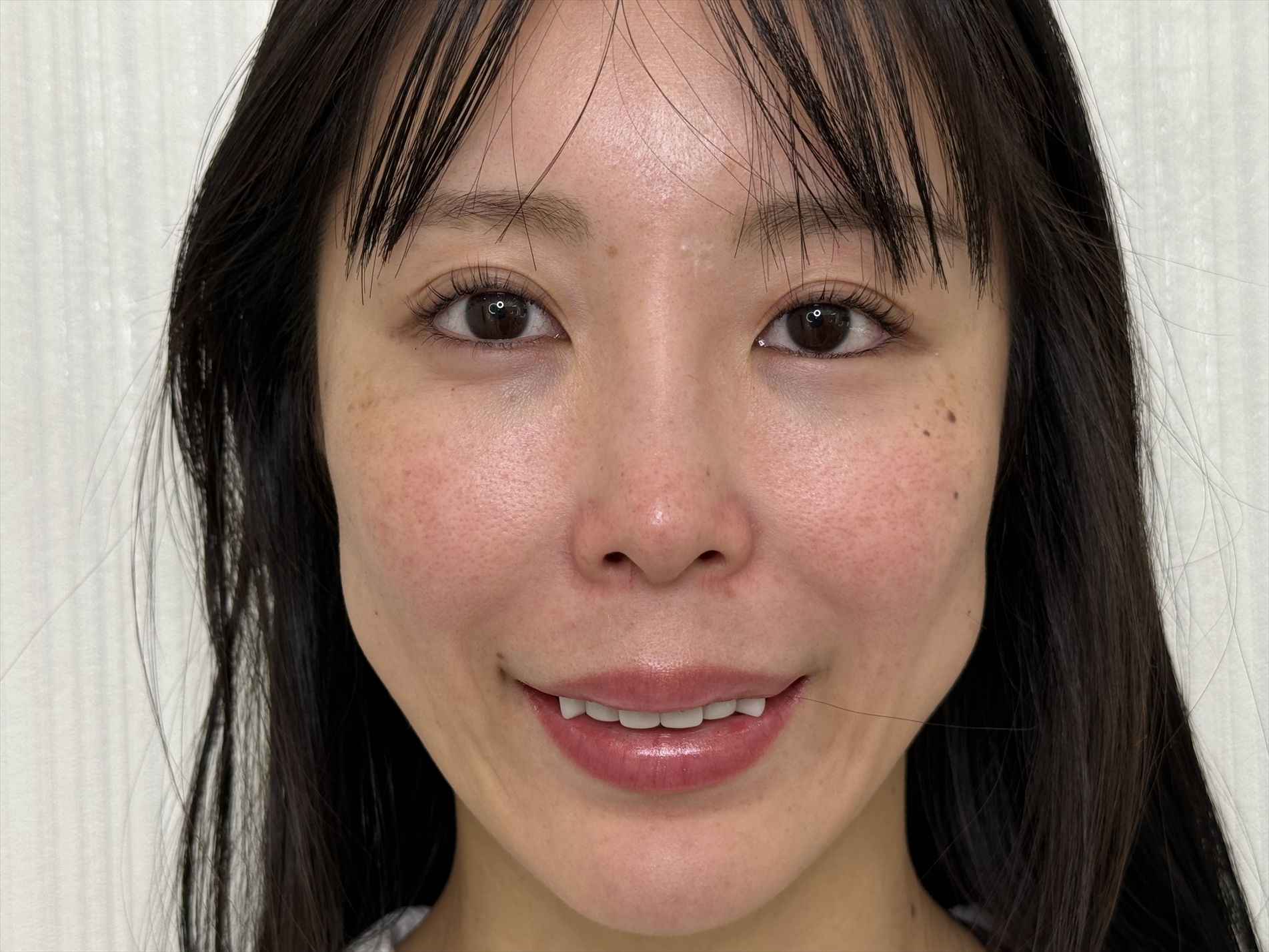 口ゴボ、出っ歯の治療①